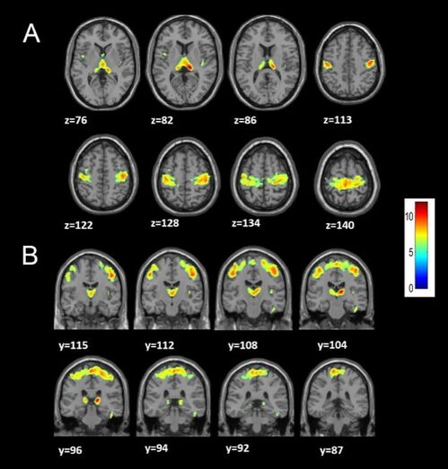 ¿Qué ocurre en el cerebro de los pacientes con hernias cervicales?