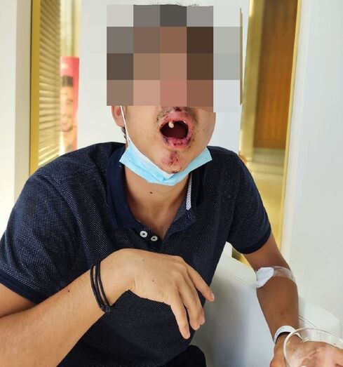 Un joven, en tratamiento psicológico tras perder tres dientes por una brutal paliza